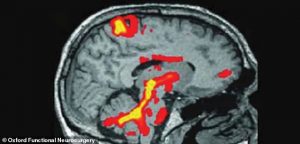 Black Mirror-style brain implants used to treat Parkinson’s could be manipulated to steal memories and BLACKMAIL people by 2038