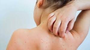 Unprecedented’ 100,000 people hit by EU measles outbreak – as deadly disease spreads at terrifying rate