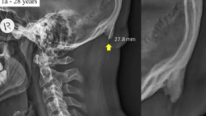 We’re now growing little skull horns because of our phones, research finds