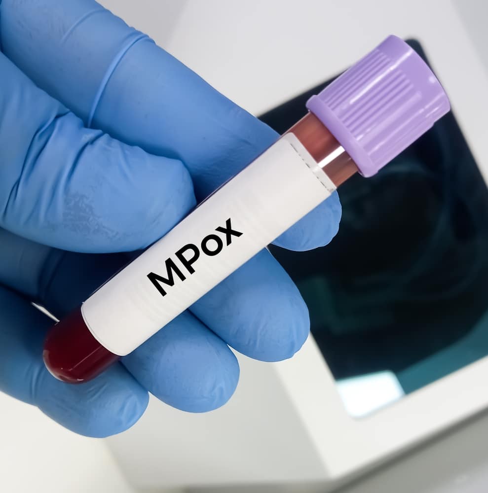 Sweden reports first case of deadly mpox strain outside Africa