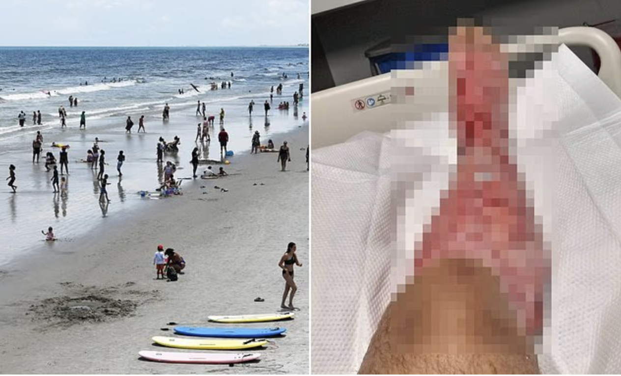 Deadly flesh-eating bacteria spreading across beaches… as cases surge in terrifying rise